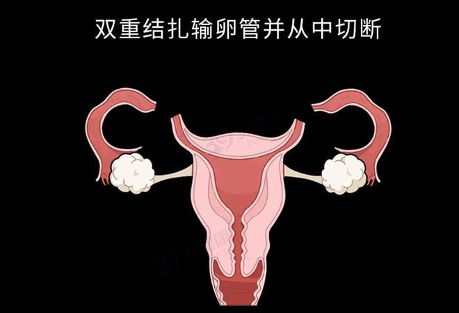 做了输卵管结扎还能怀孕吗(输卵管结扎对女性有什么影响)