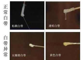 分泌物像豆腐渣用什么药(什么是白带正常图片)