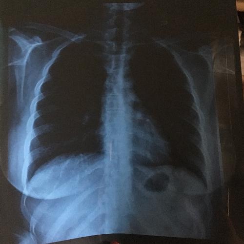 做x胸片多久可以怀孕(拍片子后多久可以怀孕）