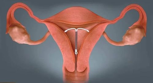 取环后可以清洗外阴吗取环后也要注意清洁(环取了多久可以洗下身子宫）