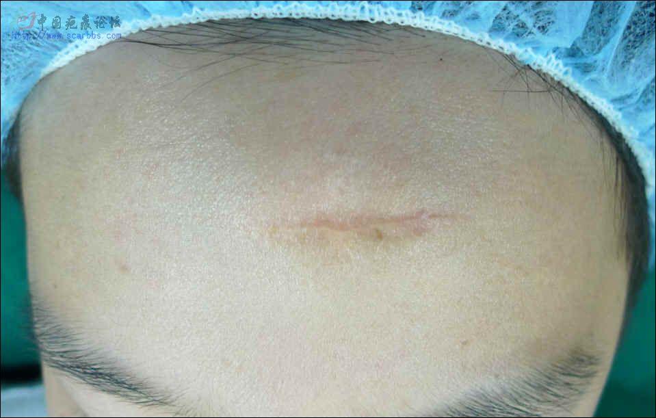 剖腹产十个月会怀孕吗(剖腹产后13个月怀孕可以要吗）