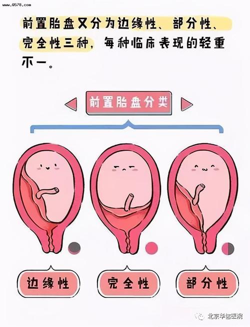 凶险性前置胎盘什么时候最危险(胎盘血池孕妇要注意什么)