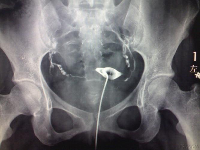 输卵管造影检查前后的注意事项(输卵管检查有哪些）