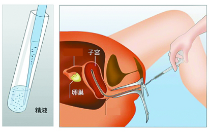 人工授精会不会宫外孕并不就是万无一失(人工授精可以避免宫外孕吗）