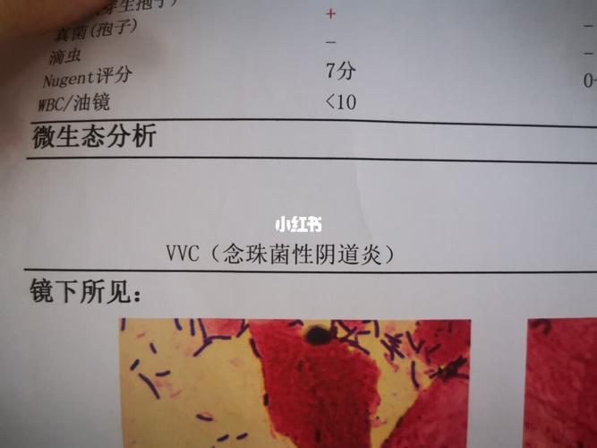 分泌物像豆腐渣用什么药(什么是白带正常图片)