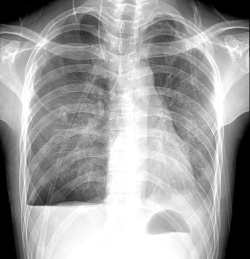 做了胸片多久可以备孕(做了胸片后发现怀孕了有影响吗)