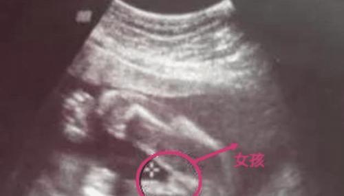 胎儿的性别什么时候能够确定(什么时候可以知道胎儿性别）