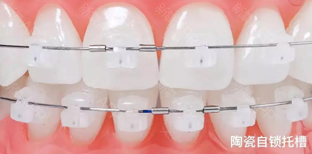 做瓷托槽可以怀孕吗(怀孕身上的肉瓷实了好吗）