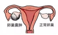 卵巢囊肿是严重的病吗(暖巢囊卵巢怎么引起的）