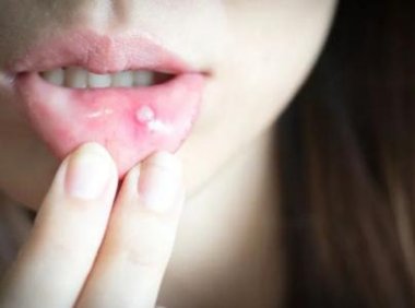 口腔溃疡喝热水还是冷水好(口腔溃疡能喝凉水吗）