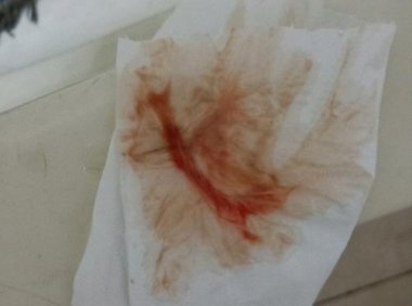 分泌物有血丝怎么回事(白带里有轻微血丝是怎么回事）