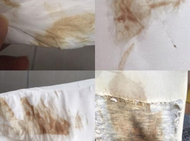 褐色的白带如何调理(黑褐色分泌物怎么回事没来月经）