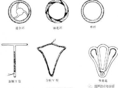 节育环下移的诊断标准(环下移b超诊断标准）