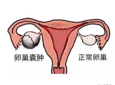 卵巢囊肿是严重的病吗(暖巢囊卵巢怎么引起的）