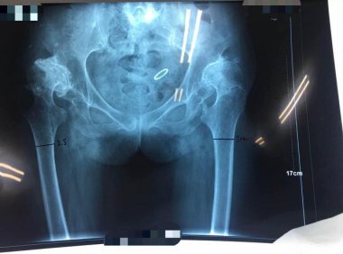 双髋置换后可以怀孕吗(双侧髋关节置换后能和正常人一样么）