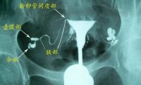 输卵管粘连怎么治(正常的输卵管造影片子)