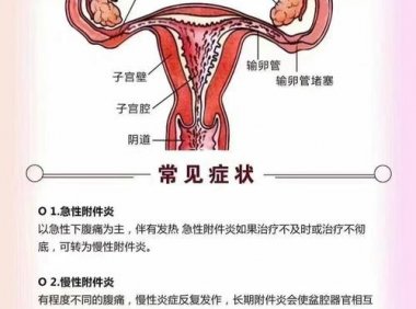 输卵管炎是附件炎吗(盆腔炎是输卵管炎吗）