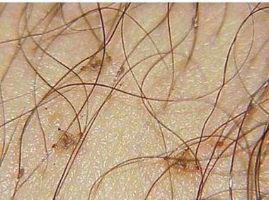 阴虱可以用盐水清洗吗阴虱怕盐吗？(白醋和盐可以杀死阴虱吗）