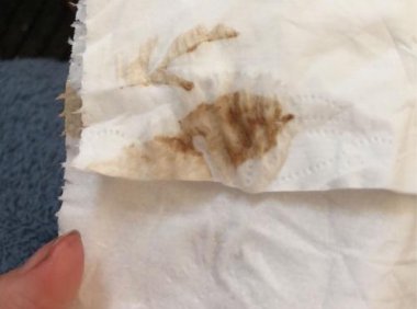 非经期有少量出血褐色是怎么回事(没来月经但是有褐色血）