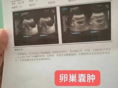 附件囊肿如何治疗(右侧卵巢囊肿怎么办）