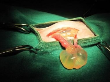 输卵管系膜囊肿怎么引起的(输卵管系膜囊肿怎么治疗)