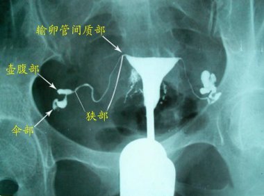 输卵管粘连怎么治(正常的输卵管造影片子)