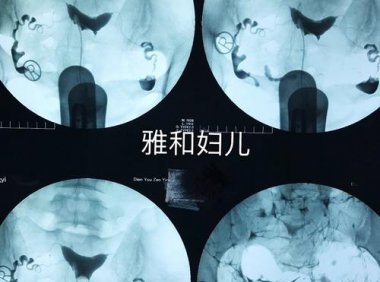 输卵管造影后多久可以要孩子(做输卵管造影术后悔了）